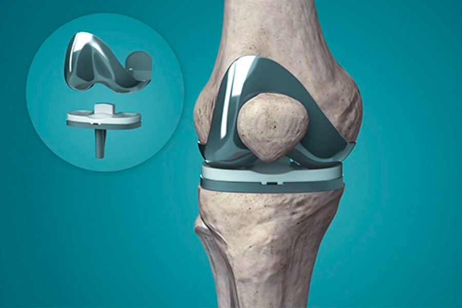 Customized titanium alloy knee joint implant